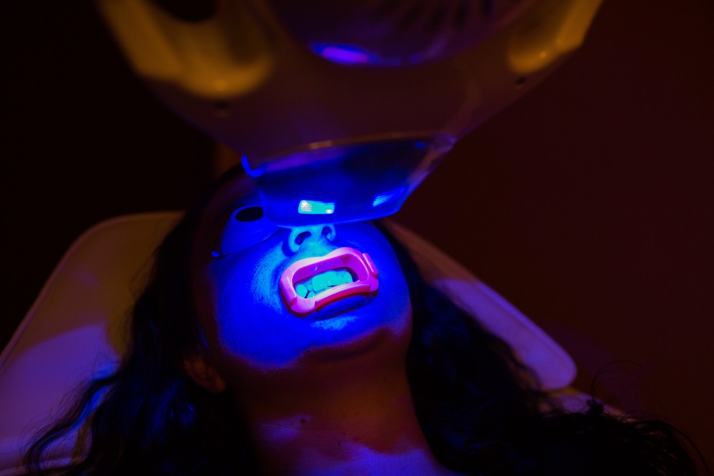 Professional Teeth Whitening Without A Dentist