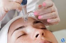 Microneedling Treatment In National city