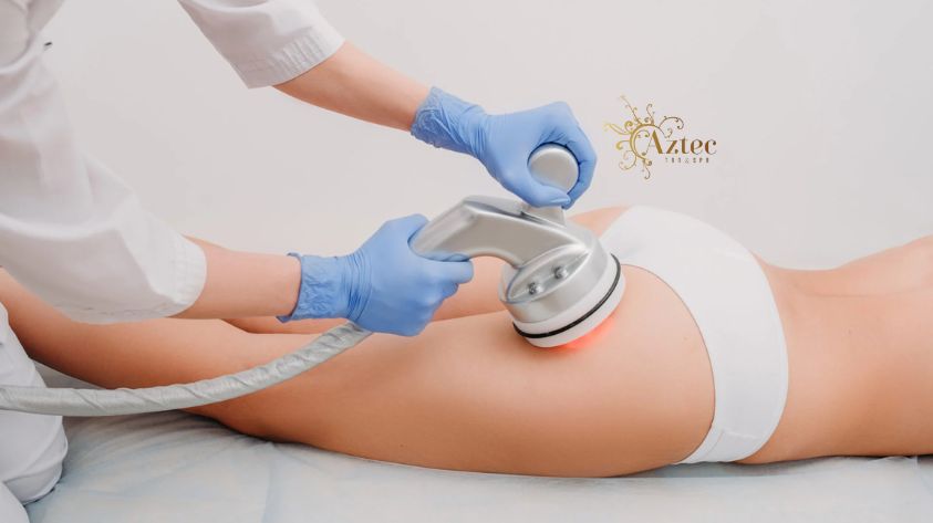 Cellulite Treatment in Mission Valley