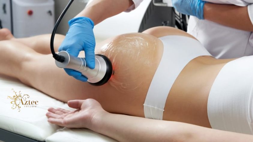 Cellulite Treatment in Mission Valley