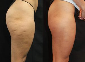 Cellulite treatment san diego