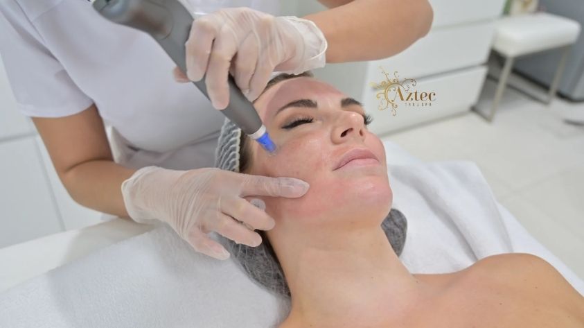 Microneedling Treatments