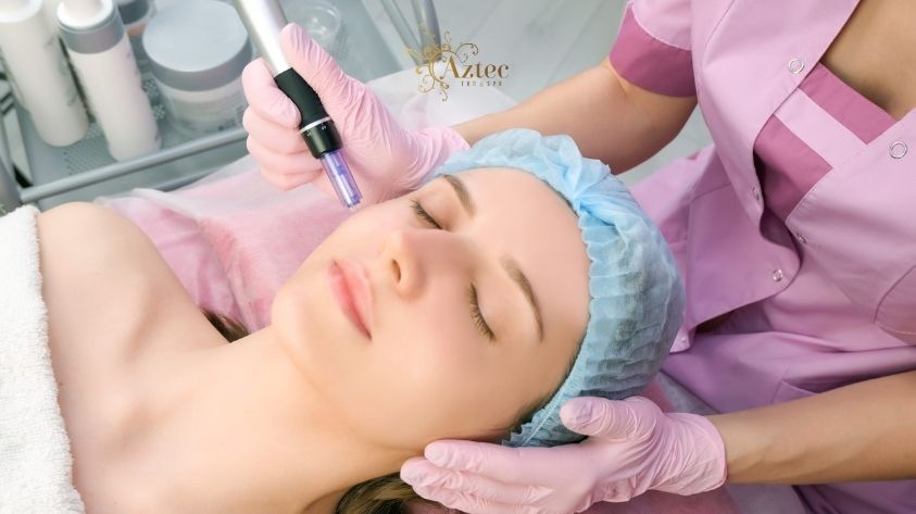 Microneedling Treatments