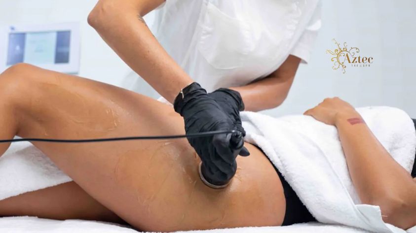 radio frequency​ and fat cavitation