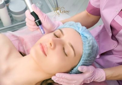 Microneedling Treatments